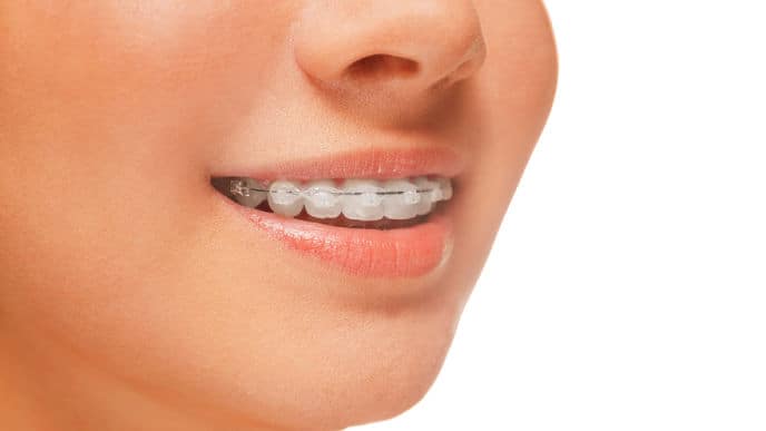 Achieving a Perfect Smile with Self-Ligating Braces in Malaysia